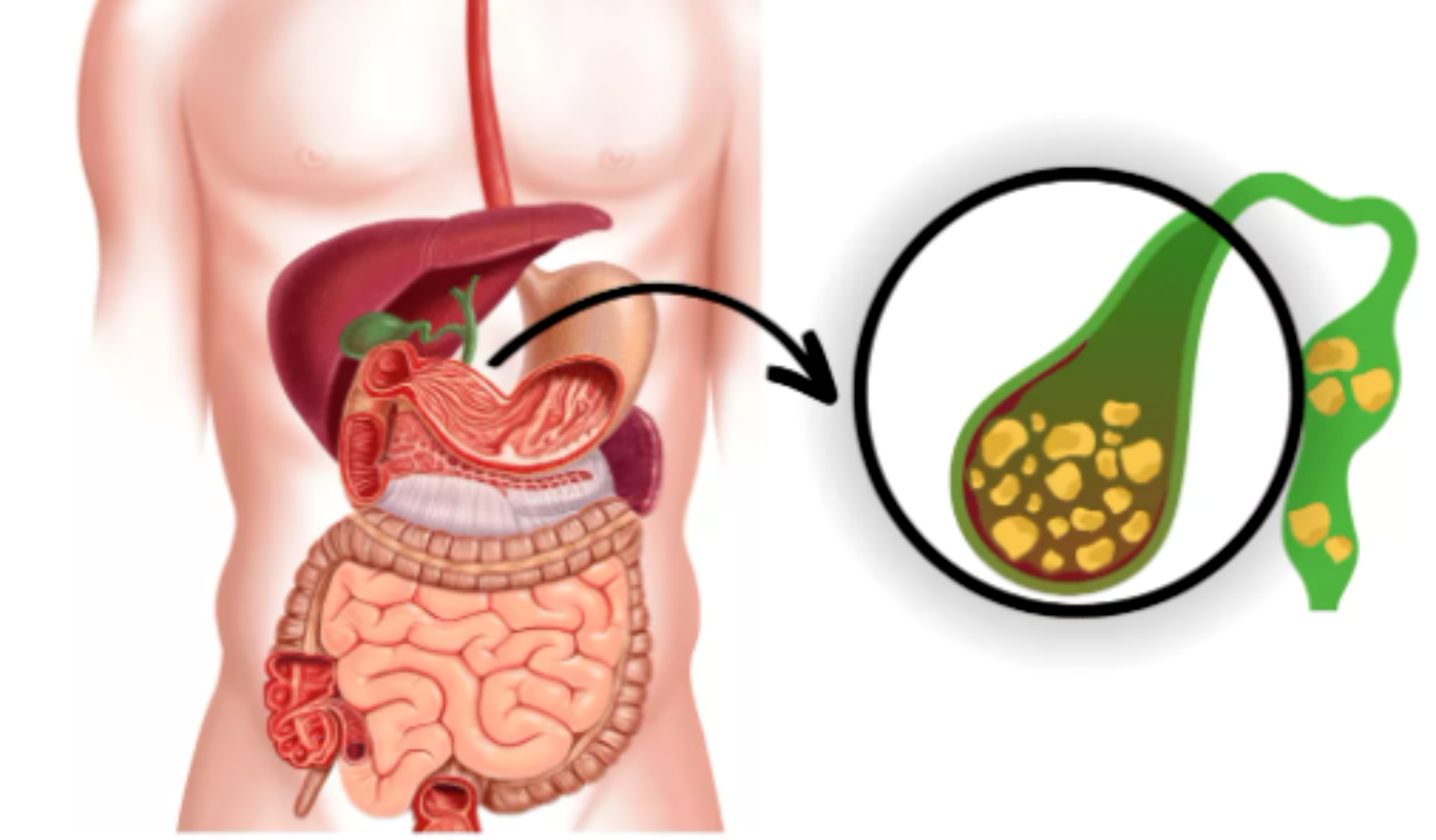 क्या पित्त की पथरी नींबू का रस पीने से गलती है? सच और सही जानकारी